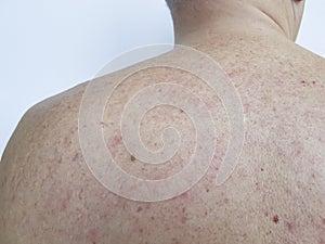Birthmark pimples on the back men bad skin clinic