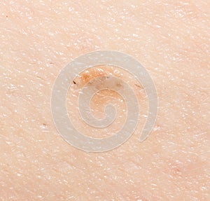 Birthmark on the skin. close