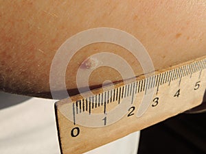 Birthmark on the skin