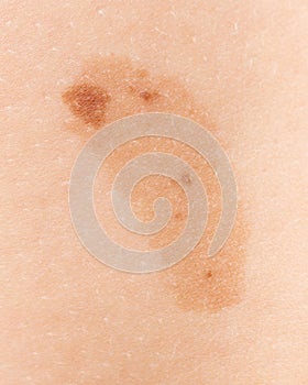 Birthmark on the skin of a person
