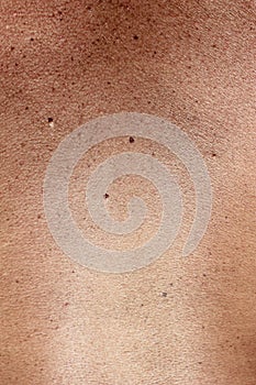 Birthmarks on the skin