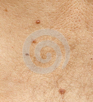 Birthmarks on the skin as a background