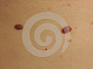 Birthmarks on the skin