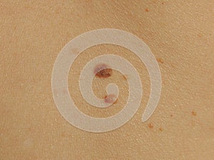 Birthmarks on the skin