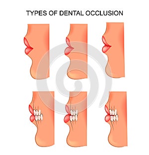 Bite dental. dentistry