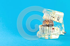 A bitten chocolate bar in a dental jaw mockup on a blue background. The concept of sweets harming tooth enamel, caries