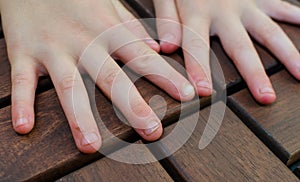 Bitten fingernails - bitten fingers. Close up of hand with bitten finger and fingernails