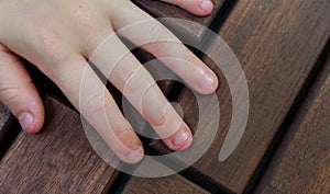 Bitten fingernails - bitten fingers. Close up of hand with bitten finger and fingernails.Close up shot of bad behavior or habit of