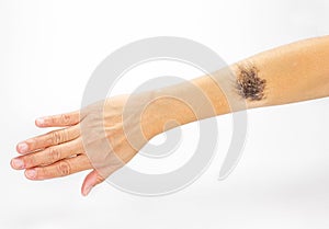 Black birthmark on arm on white background photo