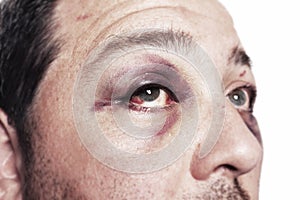 Black eye injury accident violence isolated