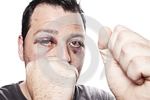 Black eye injury boxer violence isolated