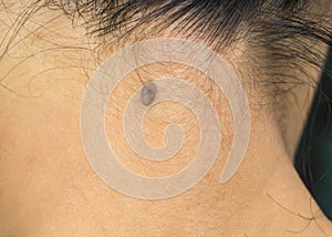 Black mole on the back neck skin of woman need CO2 Laser to removal.