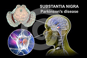 Substantia nigra, a basal banglia of the midbrain, in Parkinson's disease, 3D illustration photo