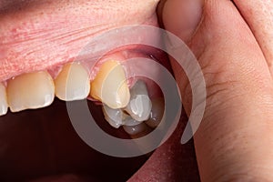 A black tooth in a man`s mouth after removal of a nerve and filling of dental canals with low-quality materials. Tooth whitening,