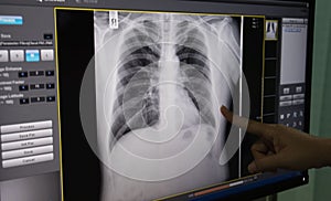 Black and white body , rib ,lung , heart , film X-ray