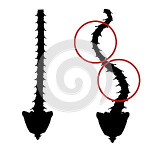 Black and white silhouette icon scoliosis. Spinal curvature, kyphosis, lordosis of the neck, scoliosis, arthrosis