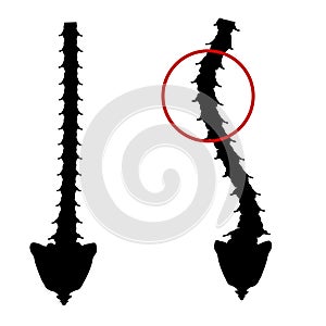 Black and white silhouette icon scoliosis. Spinal curvature, kyphosis, lordosis of the neck, scoliosis, arthrosis