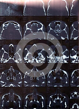 Black and white Xray (x-ray) CT paranasal sinuses coronal and axial