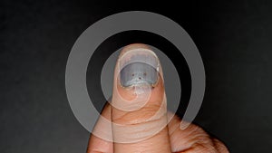 Blackened nail of hand on black background