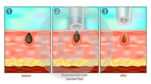 Blackhead Removal Process Using Vacuum Suction Tool - Before and After Skin Diagram. Illustration Showing Pore Cleansing with