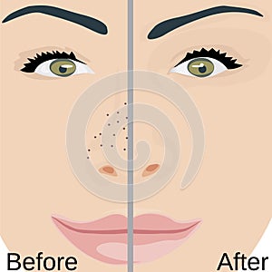 Blackheads remove on Nose treatment before and after. Pore reduce skin problems