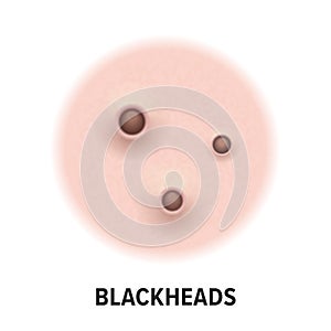 Blackheads skin acne type vector icon. Skin disease acne blackheads pimples type, face pore comedones