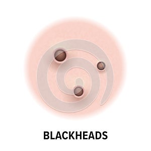Blackheads skin acne type vector icon. Skin disease acne blackheads pimples type, face pore comedones photo