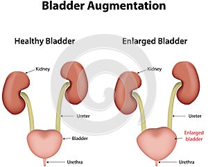 Bladder Augmentation Labeled Diagram photo