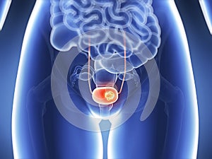 Bladder cancer