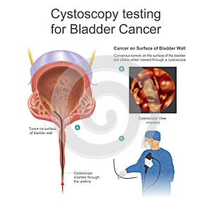 Bladder cancer is any of several types of cancer arising from th