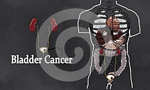 Bladder Cancer Illustration in Classic Drawing Style