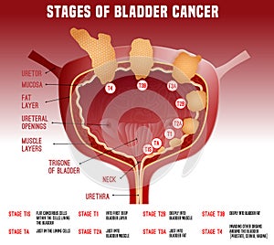 Bladder Cancer Image photo