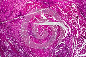 Bladder cancer, light micrograph