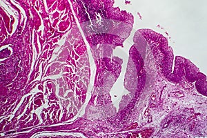 Bladder cancer, light micrograph