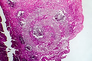 Bladder cancer, light micrograph