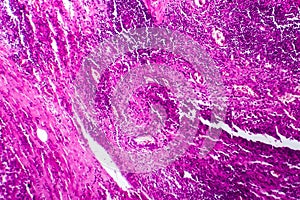 Bladder cancer, light micrograph
