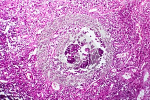 Bladder cancer, light micrograph