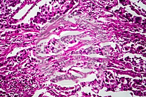 Bladder cancer, light micrograph