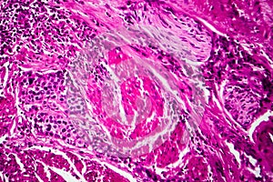 Bladder cancer, light micrograph