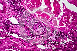 Bladder cancer, light micrograph