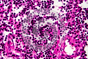 Bladder cancer, light micrograph