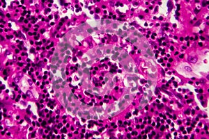 Bladder cancer, light micrograph