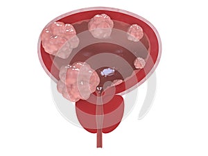 Bladder cancer stages