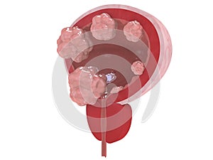 Bladder cancer stages photo