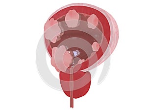 Bladder cancer stages