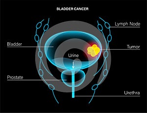 Bladder cancer stages