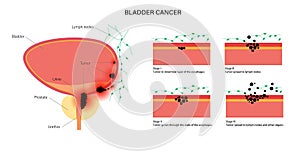 Bladder cancer stages