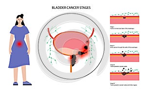 Bladder cancer stages