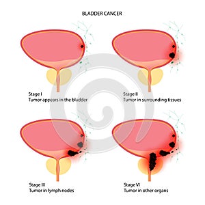 Bladder cancer stages