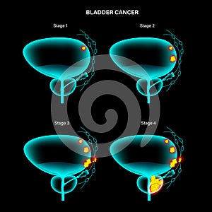 Bladder cancer stages